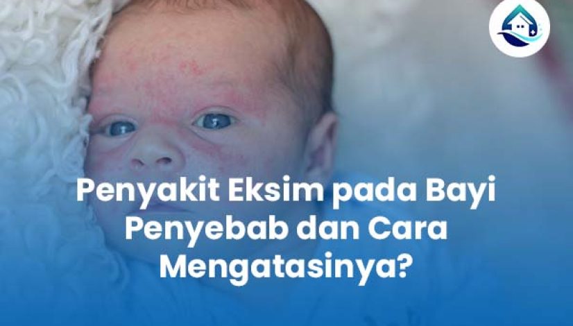 Penyakit Eksim pada Bayi Penyebab dan Cara Mengatasinya