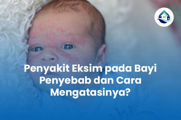 Penyakit Eksim pada Bayi Penyebab dan Cara Mengatasinya